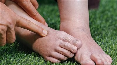 5 أعشاب تخلصك من احتباس السوائل بالجسم