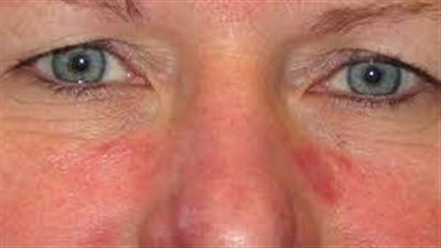 التغذية السليمة لمرضى الذئبة الحمراء للحماية من مضاعفات المرض 