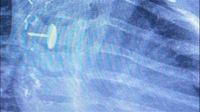 ابتلعته منذ 6 أشهر، استخراج دبوس ضغط من مريء رضيعة بمستشفى بنها التخصصي للأطفال