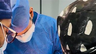 نجاح عملية نادرة لاستئصال ورم ضخم يزن 6 كجم من جدار الصدر بالتأمين الصحي الشامل