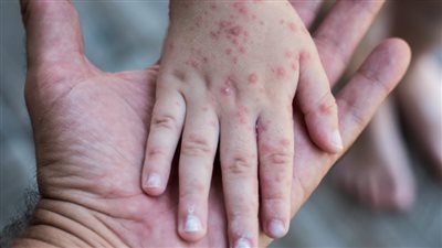 شكاوى لأولياء الأمور من تفشي الجديري المائي بين تلاميذ كفر الأشراف، وتعليم الشرقية ترد 