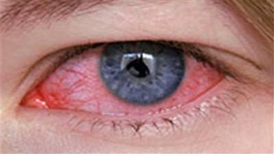 بعد الإعلان عن خلو مصر منه، تعرف على مرض التراكوما، الأسباب والأعراض