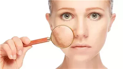 احذري، التوتر والضغط العصبي سبب رئيسي في تصبغات الجلد واسمرار البشرة