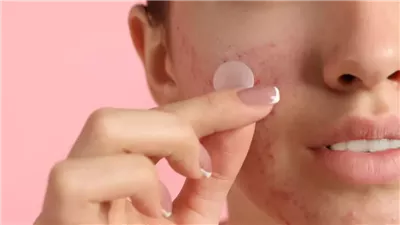 كيف تساعد ملصقات البثور في التخلص من حب الشباب؟ 