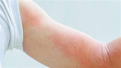 سبب الإصابة بمرض الأرتيكاريا المزمنة وكيف يمكن التعرف على محفزاتها؟