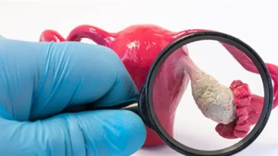 علامات بداية تكيّسات المبايض عند البنات، إشارات مبكرة لا يجب تجاهلها