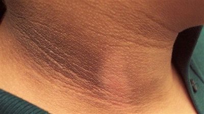 أكلات تساعد في علاج مقاومة الأنسولين 