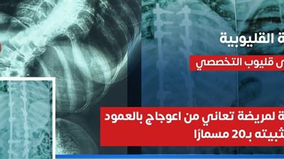 تثبيت العمود الفقري بـ20 مسمارًا، جراحة دقيقة تنقذ فتاة بمستشفى قليوب