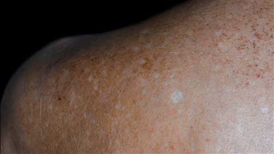 كيف تظهر البقع البيضاء على الجلد وما هي أسبابها المختلفة؟