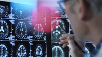 مفاجأة طبية لدواء جديد يبطئ تطور مرض الزهايمر 8 سنوات