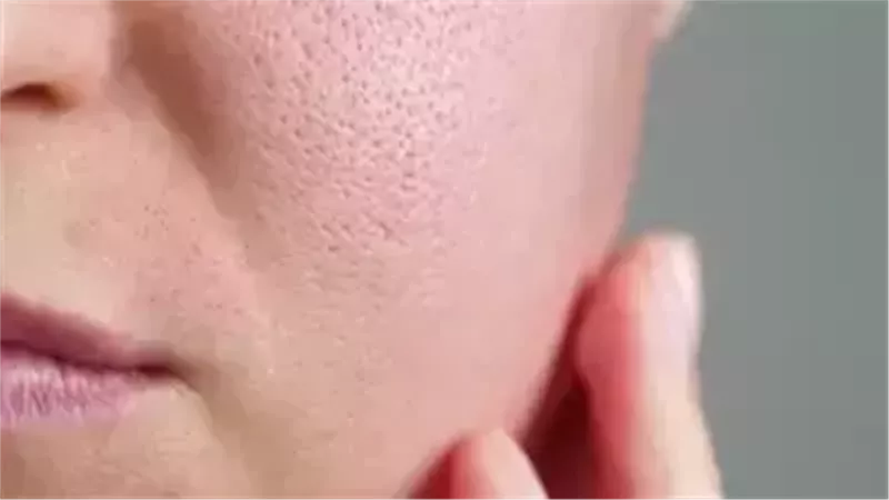 المسام الواسعة 