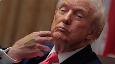 ظهر متعبًا بضمادات، بارون ترامب يثير الجدل حول صحة والده، والأطباء: مرض مناعي يهدده