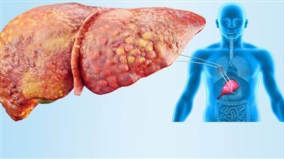 أعراض الإصابة بدهون الكبد وطرق علاجها 