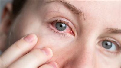 أسباب أحمرار العين عند الاستيقاظ، ومتى يجب استشارة الطبيب؟