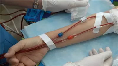 لمرضى الفشل الكلوي، نصائح يجب اتباعها عند جلسات الغسيل 