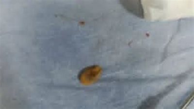 فريق طبي ينجح في استخراج “حبة لب” من الشعب الهوائية لطفل بالقليوبية