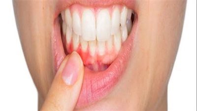 3 أسباب للإصابة بإلتهاب اللثة 