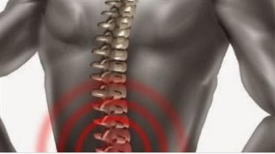 5 تمارين رياضية للتخلص من تقوس وانحناء الظهر