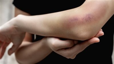  أسباب البقع الزرقاء التي تظهر بالجسم فجأة