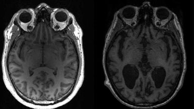 يصيب الشباب.. مرض عصبي غامض يضرب كندا والسلطات تحذر 