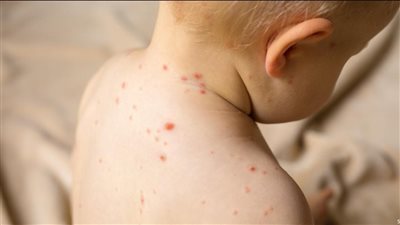 استشاري يحذر من انتشار الجديري المائي بين الأطفال