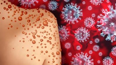 تفشي جدري القرود في الكاميرون والسلطات الصحية تتخذ قرارًا عاجلًا