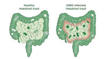 3 خطوات تساعدك في علاج مرض السيبو