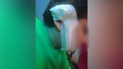 طالب يمزق وجه زميله بـ 