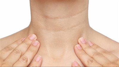 مخاطر إهمال ترطيب الرقبة فى الشتاء 