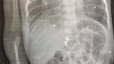 إنقاذ رضيع عمره 14 يومًا من جسم غريب بمستشفى ناصر التخصصي