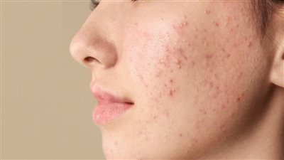  أفضل طريقة تخلصك من حب الشباب وآثاره على البشرة 