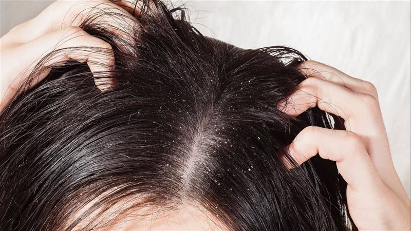 علاج قشرة الشعر