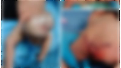 استئصال ورم نادر لطفلة عمرها يومان بمستشفى الفيوم العام 