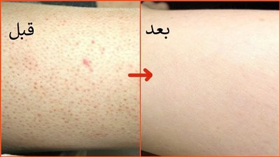 علاج جلد الوزة بالوصفات الطبيعية وفي زمن قياسي