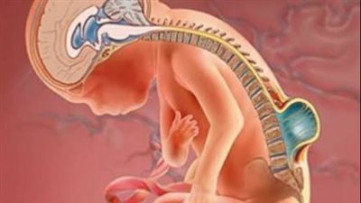 كل ما تريد معرفته عن مرض الصلب المشقوق 