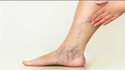 علاج الدوالي والأعراض وأسباب الإصابة