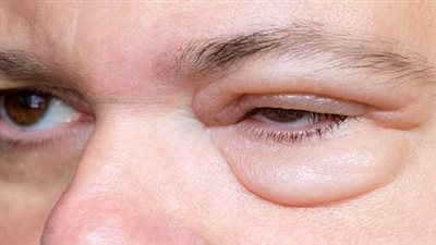  كل ما تودين معرفته عن انتفاخ العين.. الأسباب وطرق العلاج