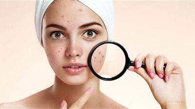 معرفة السبب أهم خطوة.. علاج حبوب الوجه بمواد طبيعية من مطبخك
