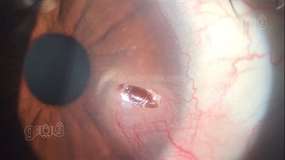 نجاح عملية جراحية بقرنية العين لخبير روسي بمستشفى الضبعة | صور