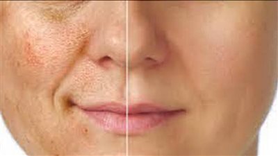 6 طرق علاجية للتخلص من تصبغات الوجه