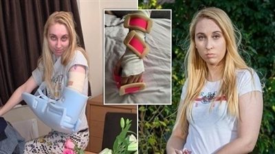 بسبب غرسة منع الحمل.. إصابة بريطانية بشلل في الذراع