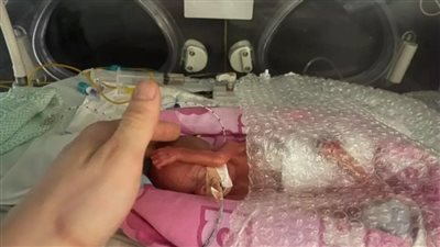 تحمل على راحة اليد.. ولادة أصغر طفلة في بريطانيا خلال عقدين | صور