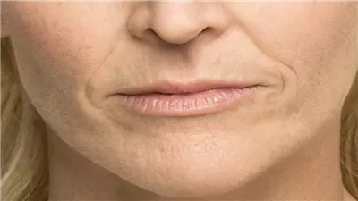 وصفة طبيعية لعلاج الخطوط الرفيعة حول الفم