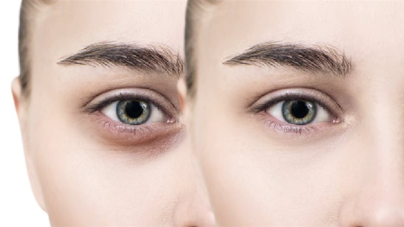 علاج الهالات السوداء،