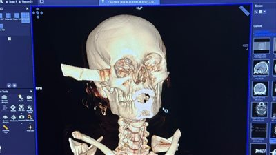 قصر العيني يكشف تفاصيل استخراج سكين من جمجمة مريضة