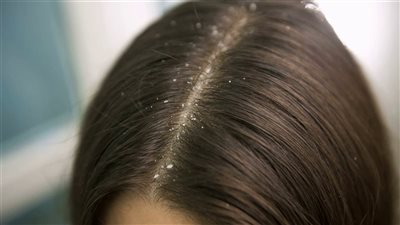 طرق طبيعية للتخلص من قشرة الشعر بعد انتهاء الشتاء 