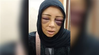 دخل عليا الكوافير وضربني، فتاة ببورسعيد تكشف تفاصيل اعتداء خطيبها السابق عليها والداخلية تضبطه