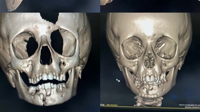 مستشفى شربين المركزي ينجح في إجراء جراحة دقيقة لفك طفل 