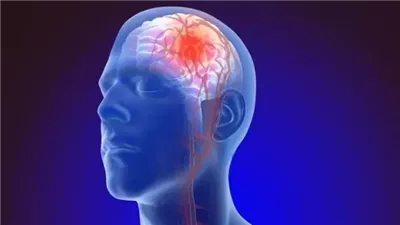 الصحة: جلطة المخ تبدأ بأعراض مفاجئة واحذر تجاهل هذه العلامات