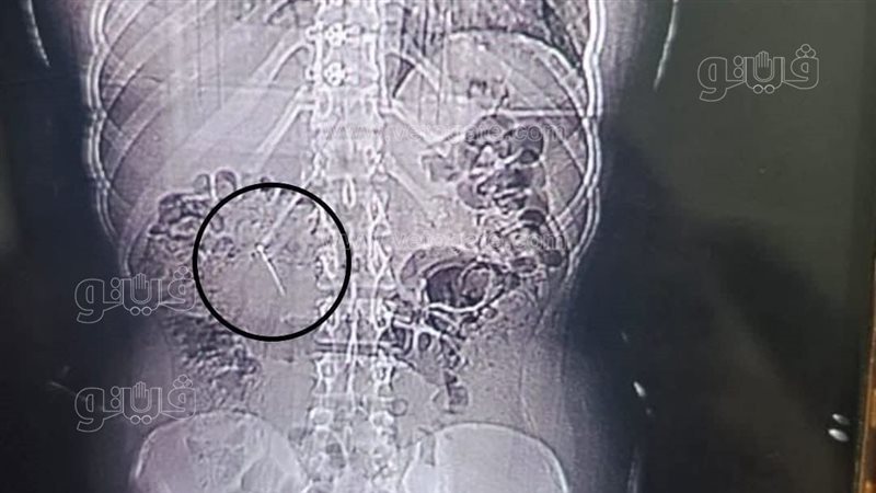 أطباء الشفاء ينتزعون